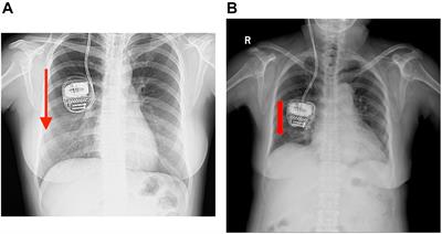 Recharging Difficulty With Pulse Generator After Deep Brain Stimulation: A Case Series of Five Patients